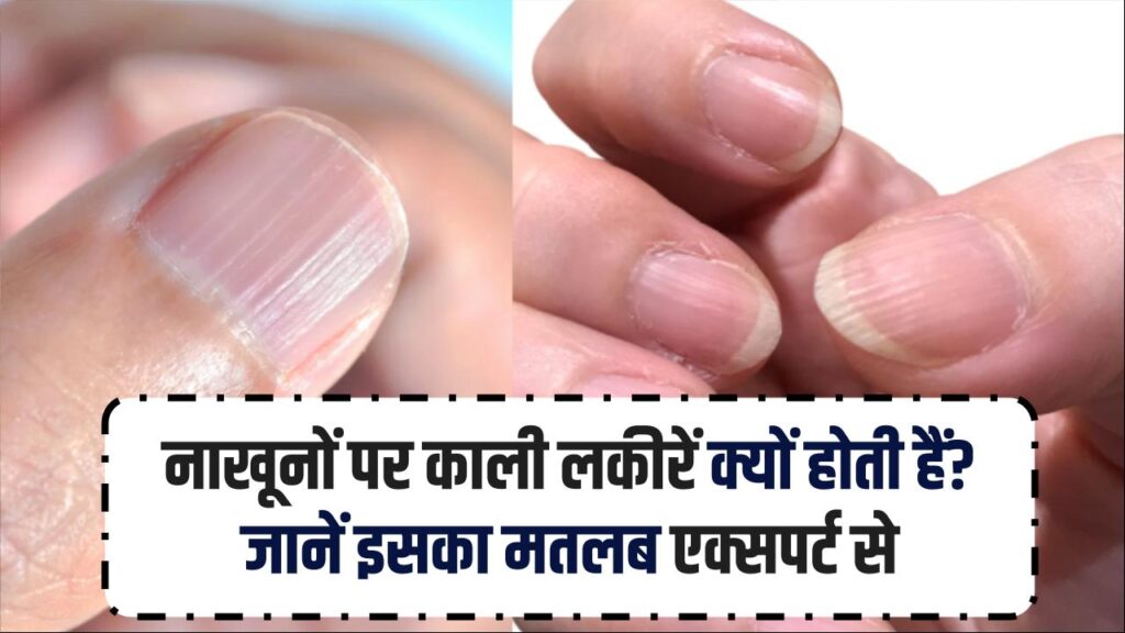 नाखूनों पर काली लकीरें क्यों होती हैं? जानें इसका मतलब एक्सपर्ट से